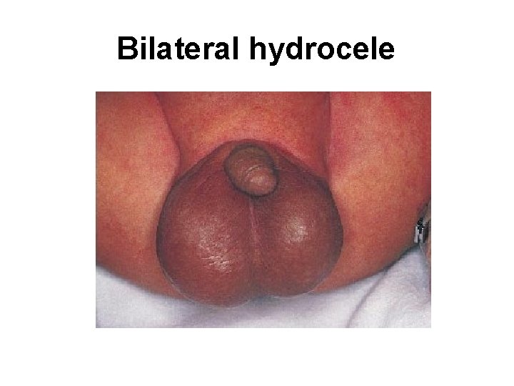 Bilateral hydrocele 
