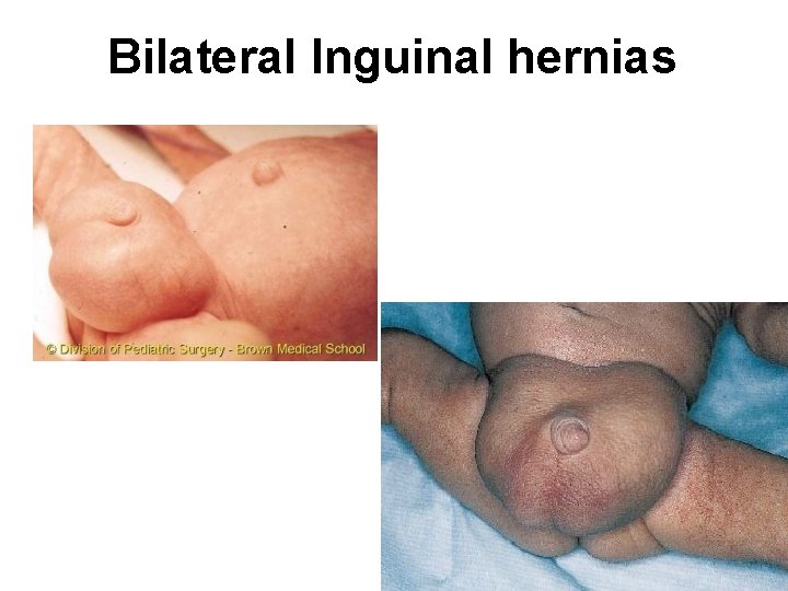 Bilateral Inguinal hernias 