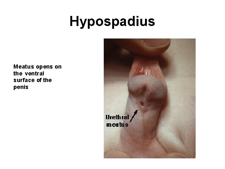 Hypospadius Meatus opens on the ventral surface of the penis 
