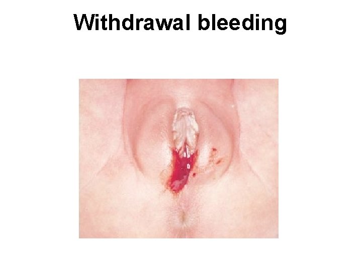 Withdrawal bleeding 