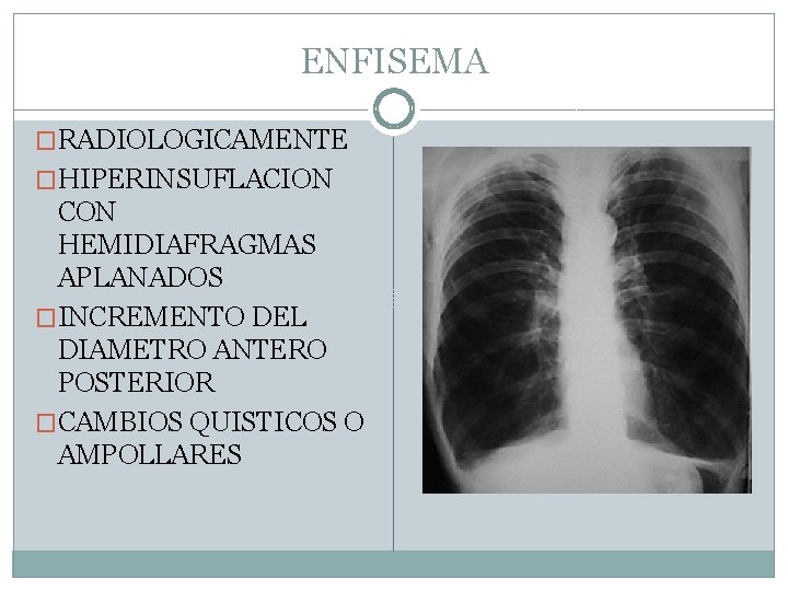 ENFISEMA �RADIOLOGICAMENTE �HIPERINSUFLACION CON HEMIDIAFRAGMAS APLANADOS �INCREMENTO DEL DIAMETRO ANTERO POSTERIOR �CAMBIOS QUISTICOS O