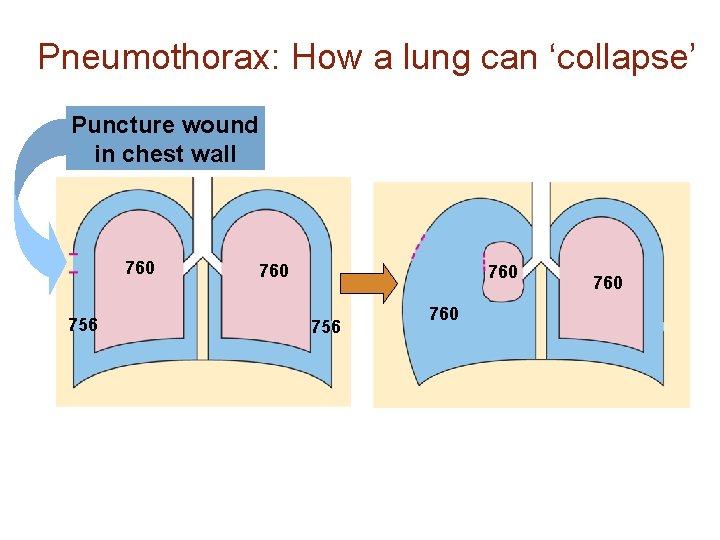 Pneumothorax: How a lung can ‘collapse’ Puncture wound in chest wall 760 756 760