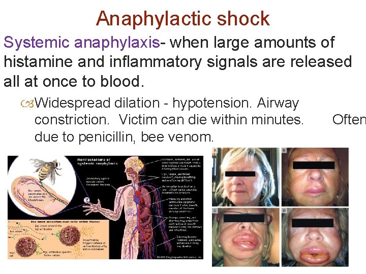 Anaphylactic shock Systemic anaphylaxis- when large amounts of histamine and inflammatory signals are released