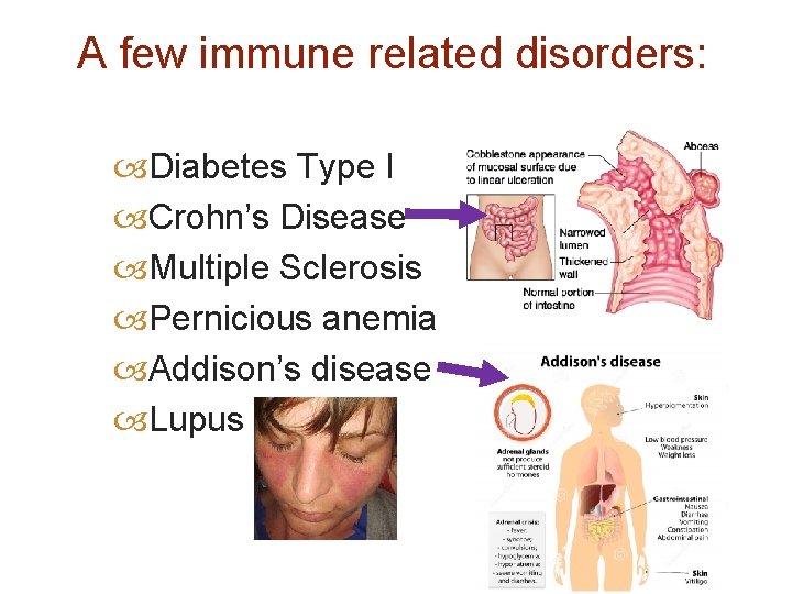 A few immune related disorders: Diabetes Type I Crohn’s Disease Multiple Sclerosis Pernicious anemia