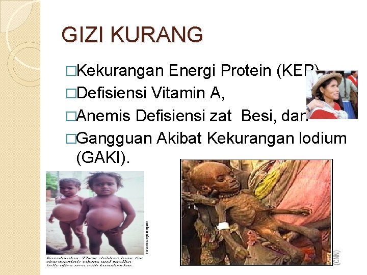 GIZI KURANG �Kekurangan Energi Protein (KEP), �Defisiensi Vitamin A, �Anemis Defisiensi zat Besi, dan
