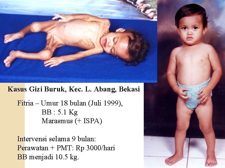 Kasus Gizi Buruk, Kec. L. Abang, Bekasi Fitria – Umur 18 bulan (Juli 1999),