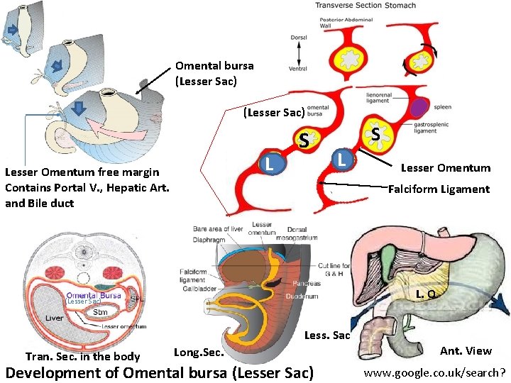 Omental bursa (Lesser Sac) L Lesser Omentum free margin Contains Portal V. , Hepatic