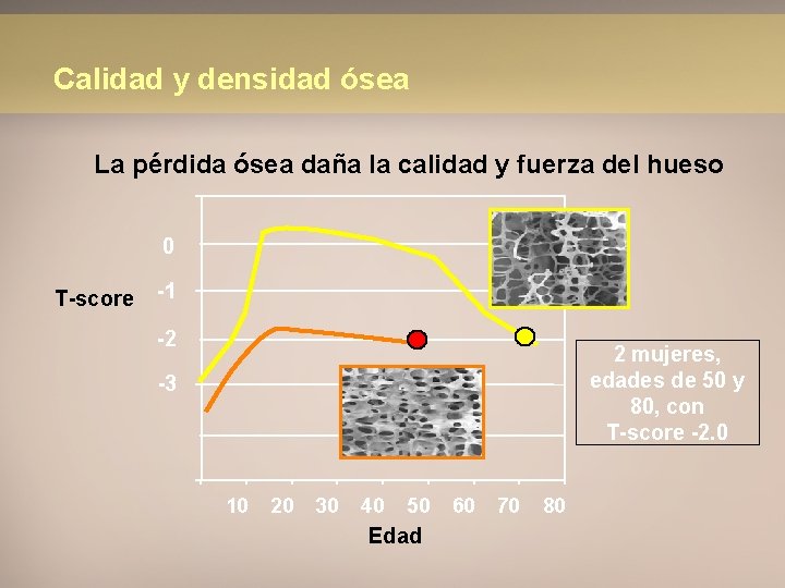 Calidad y densidad ósea La pérdida ósea daña la calidad y fuerza del hueso