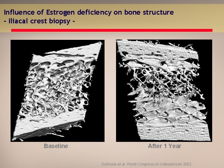 Influence of Estrogen deficiency on bone structure - Iliacal crest biopsy - Baseline After