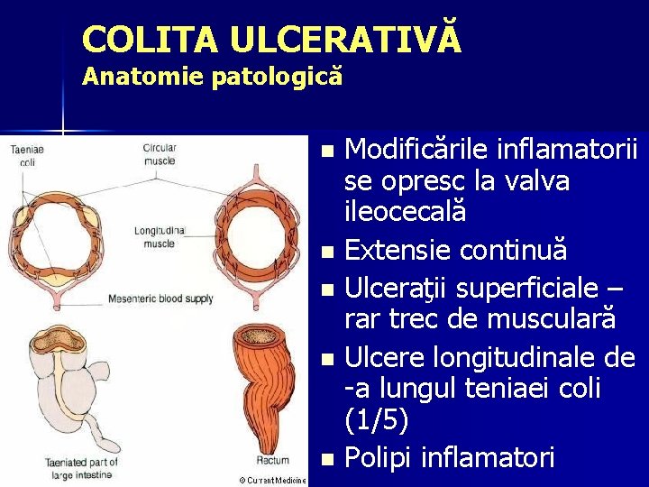 COLITA ULCERATIVĂ Anatomie patologică Modificările inflamatorii se opresc la valva ileocecală n Extensie continuă