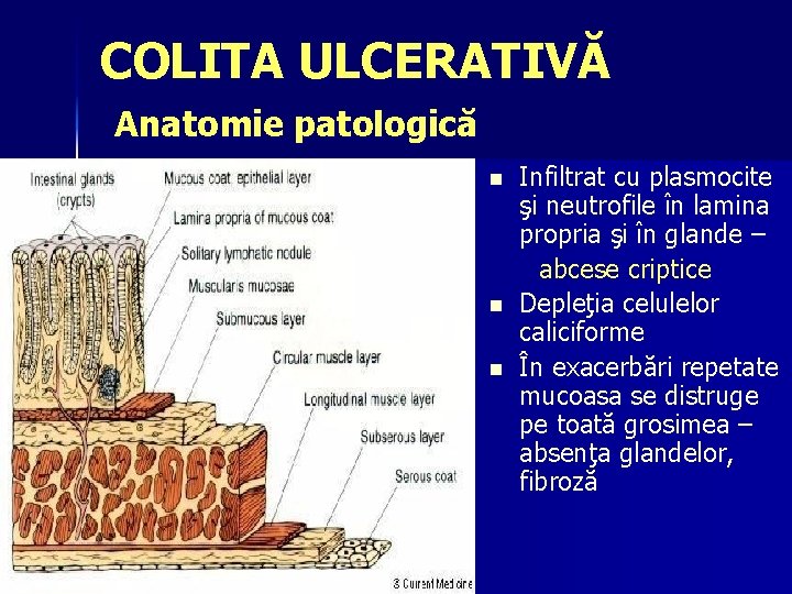 COLITA ULCERATIVĂ Anatomie patologică n n n dr cora pop BII Infiltrat cu plasmocite