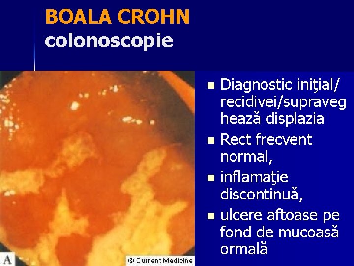 BOALA CROHN colonoscopie Diagnostic iniţial/ recidivei/supraveg hează displazia n Rect frecvent normal, n inflamaţie