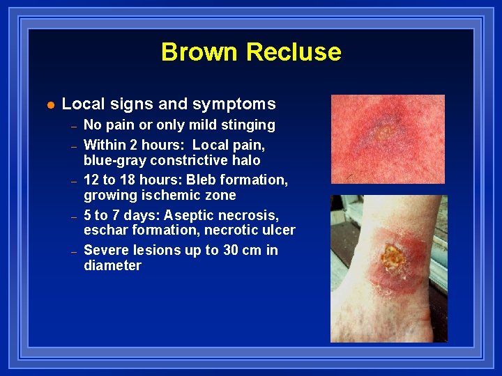 Brown Recluse l Local signs and symptoms – – – No pain or only