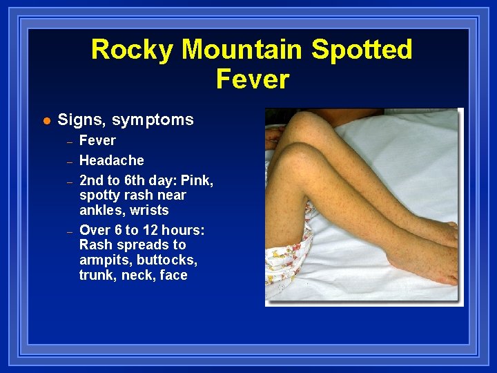 Rocky Mountain Spotted Fever l Signs, symptoms – – Fever Headache 2 nd to