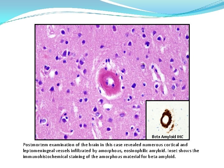 Beta Amyloid IHC Postmortem examination of the brain in this case revealed numerous cortical