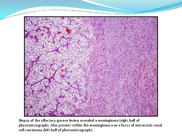 Biopsy of the olfactory-groove lesion revealed a meningioma (right half of photomicrograph). Also present