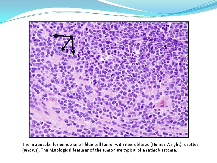 The intraocular lesion is a small blue cell tumor with neuroblastic (Homer Wright) rosettes