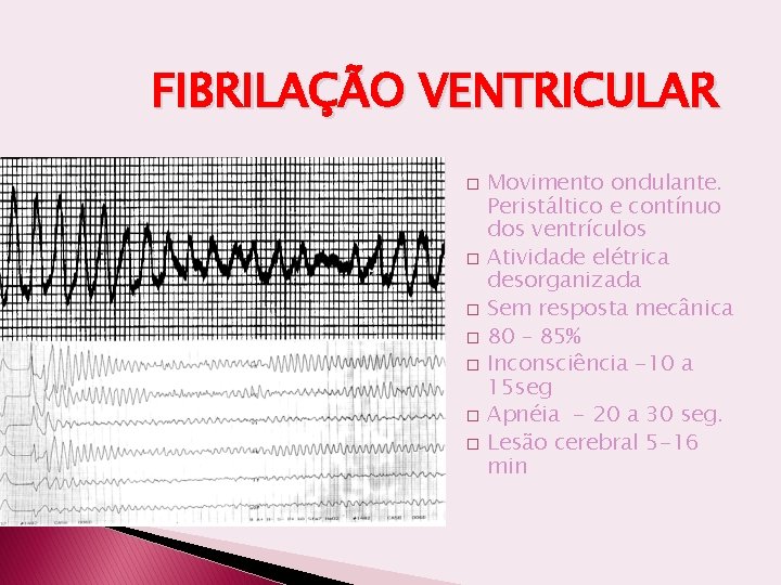 FIBRILAÇÃO VENTRICULAR � � � � Movimento ondulante. Peristáltico e contínuo dos ventrículos Atividade