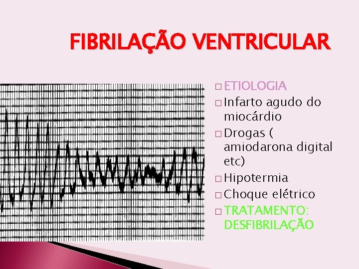 FIBRILAÇÃO VENTRICULAR � ETIOLOGIA � Infarto agudo do miocárdio � Drogas ( amiodarona digital