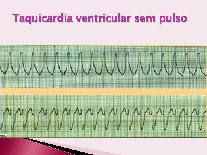 Taquicardia ventricular sem pulso 