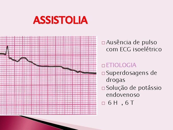 ASSISTOLIA � Ausência de pulso com ECG isoelétrico � ETIOLOGIA � Superdosagens de drogas