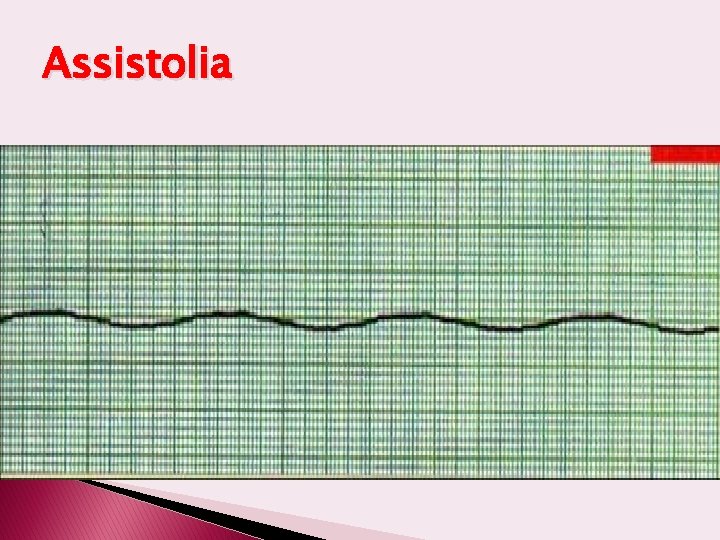 Assistolia 