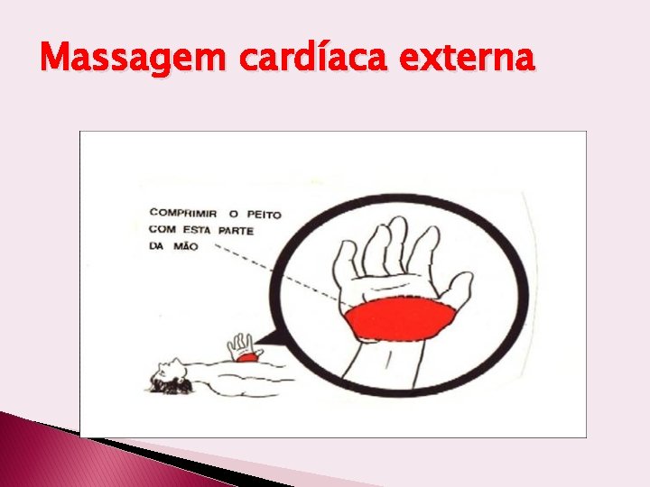 Massagem cardíaca externa 