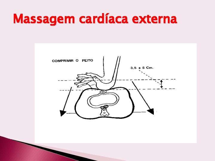 Massagem cardíaca externa 