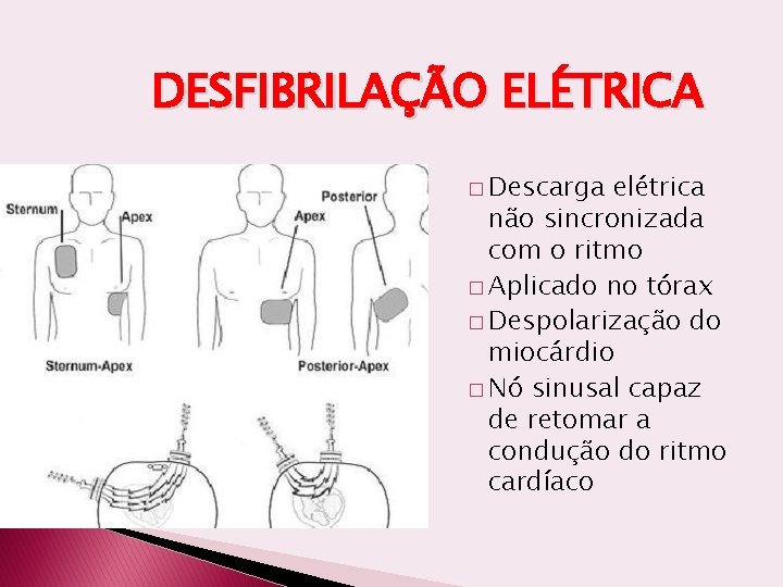 DESFIBRILAÇÃO ELÉTRICA � Descarga elétrica não sincronizada com o ritmo � Aplicado no tórax