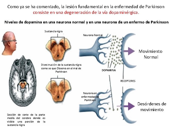 Como ya se ha comentado, la lesión fundamental en la enfermedad de Parkinson consiste