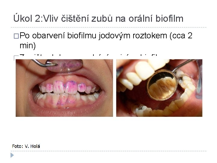 Úkol 2: Vliv čištění zubů na orální biofilm �Po obarvení biofilmu jodovým roztokem (cca