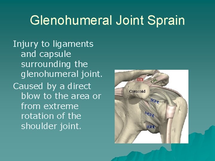 Glenohumeral Joint Sprain Injury to ligaments and capsule surrounding the glenohumeral joint. Caused by