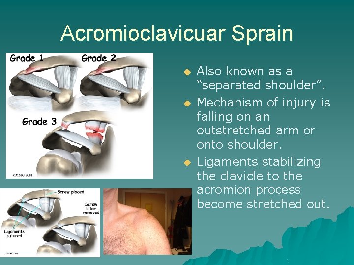 Acromioclavicuar Sprain u u u Also known as a “separated shoulder”. Mechanism of injury