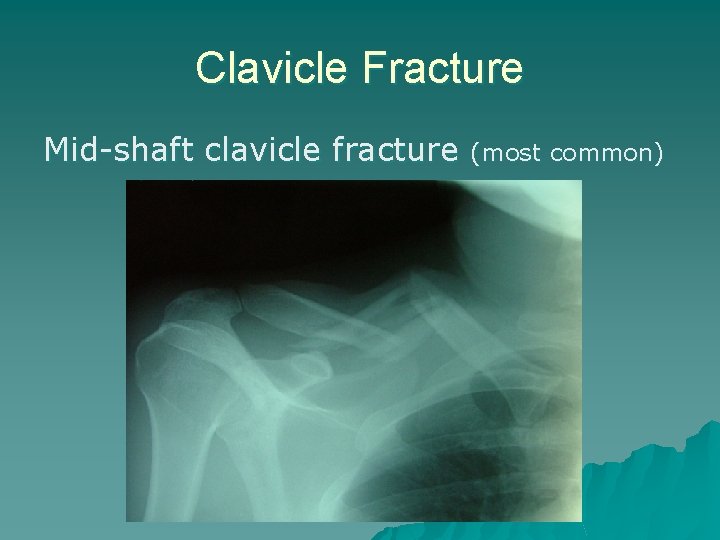 Clavicle Fracture Mid-shaft clavicle fracture (most common) 