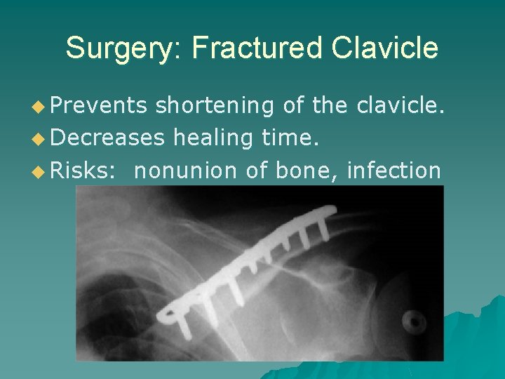 Surgery: Fractured Clavicle u Prevents shortening of the clavicle. u Decreases healing time. u