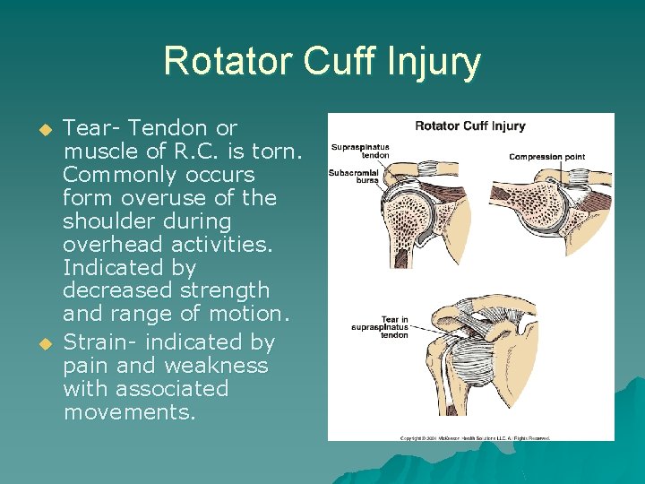 Rotator Cuff Injury u u Tear- Tendon or muscle of R. C. is torn.