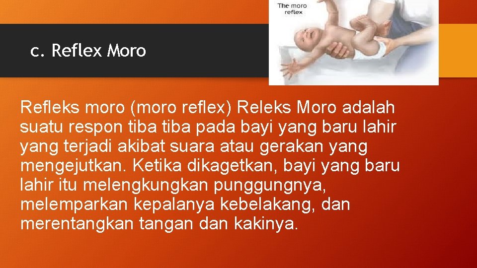 c. Reflex Moro Refleks moro (moro reflex) Releks Moro adalah suatu respon tiba pada