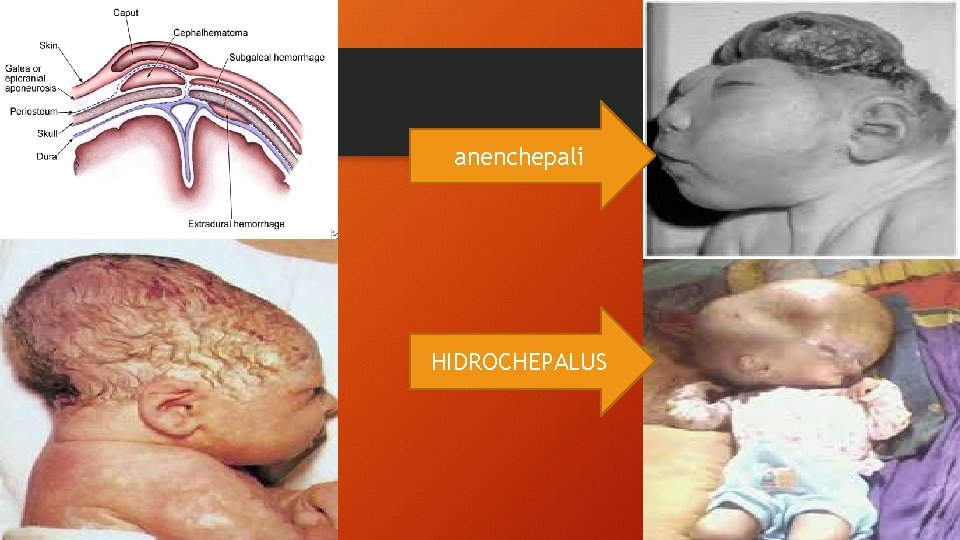 anenchepali HIDROCHEPALUS 