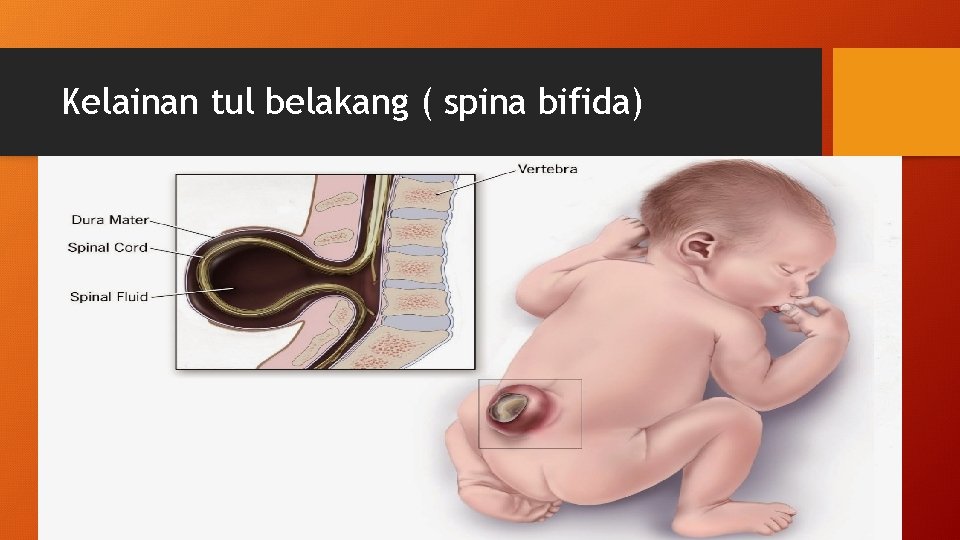 Kelainan tul belakang ( spina bifida) 