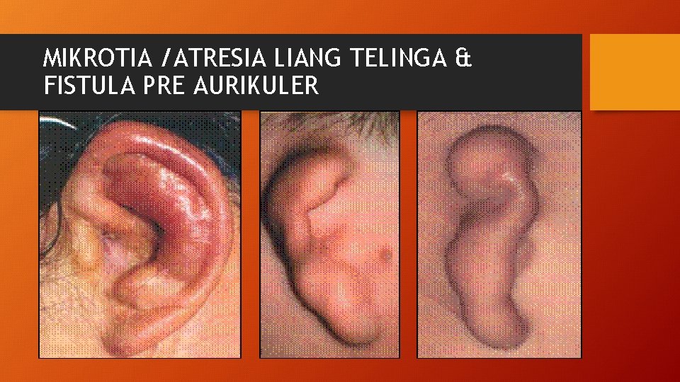 MIKROTIA /ATRESIA LIANG TELINGA & FISTULA PRE AURIKULER 
