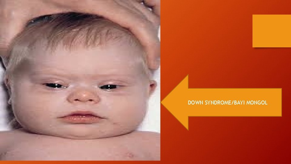 DOWN SYNDROME/BAYI MONGOL 