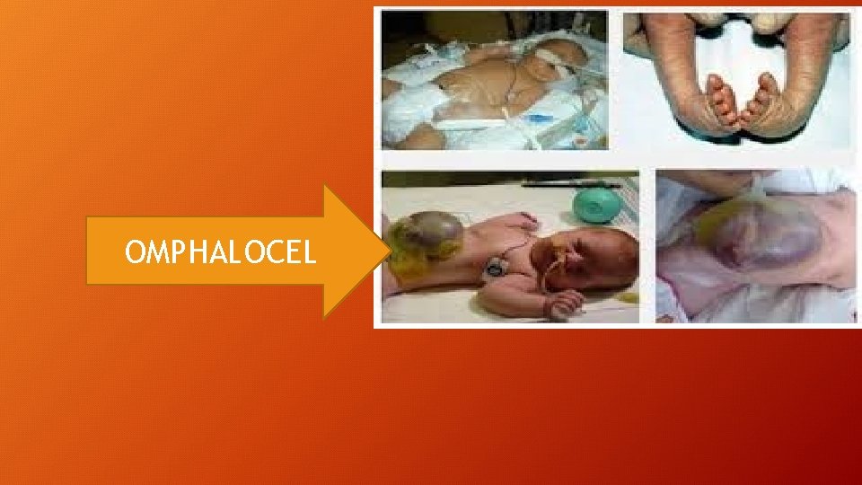 OMPHALOCEL 
