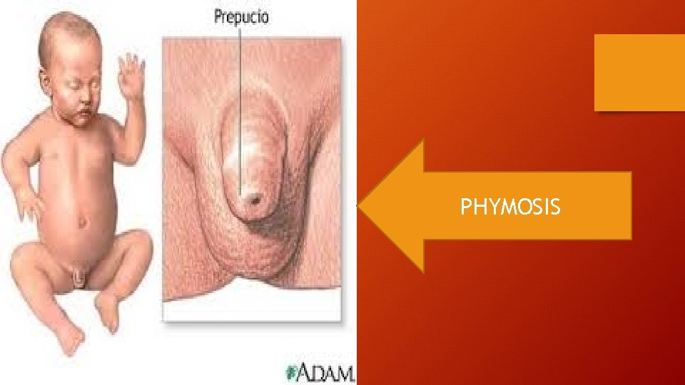 PHYMOSIS 