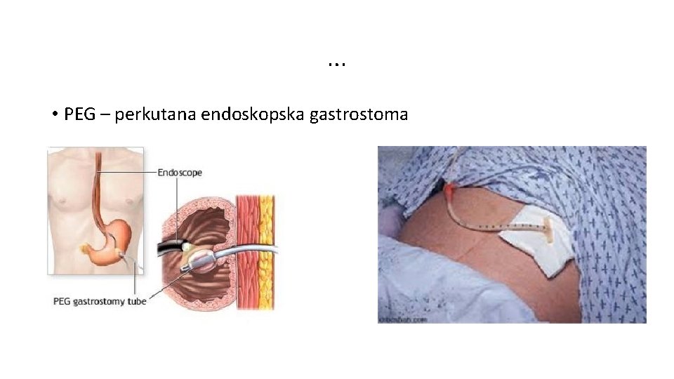 … • PEG – perkutana endoskopska gastrostoma 