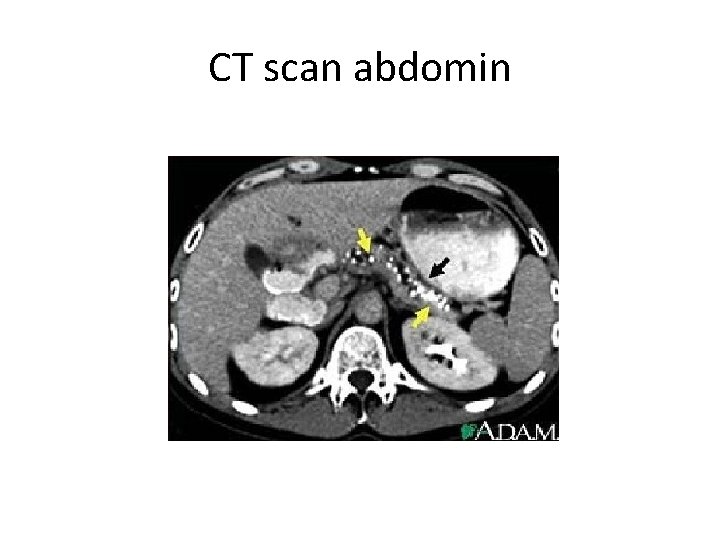 CT scan abdomin 