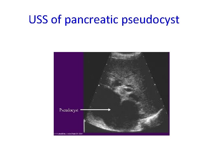 USS of pancreatic pseudocyst 