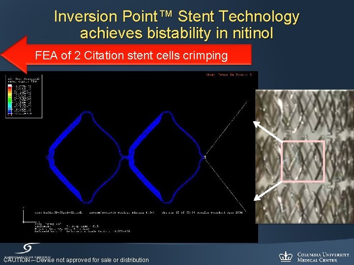 Inversion Point™ Stent Technology achieves bistability in nitinol FEA of 2 Citation stent cells