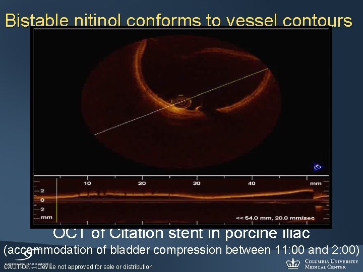 Bistable nitinol conforms to vessel contours OCT of Citation stent in porcine iliac (accommodation