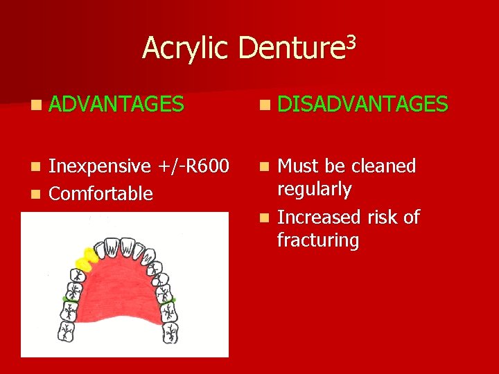 Acrylic Denture 3 n ADVANTAGES n DISADVANTAGES Inexpensive +/-R 600 n Comfortable n n