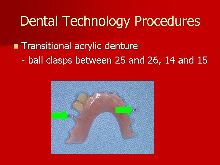 Dental Technology Procedures n Transitional acrylic denture - ball clasps between 25 and 26,